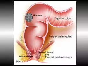 Résection antérieure du rectum