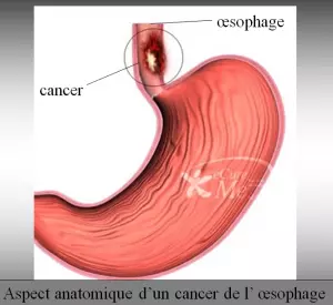 Oesophagectomie