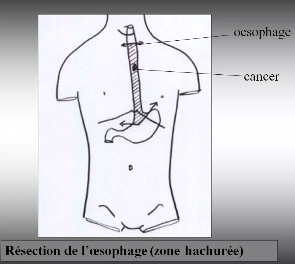 Chirurgie de l'oesophage