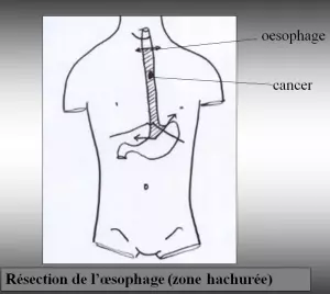 Chirurgie de l'oesophage