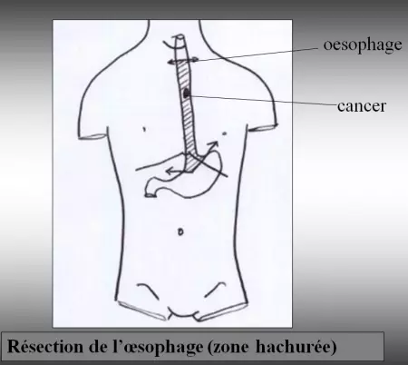 Chirurgie de l'oesophage