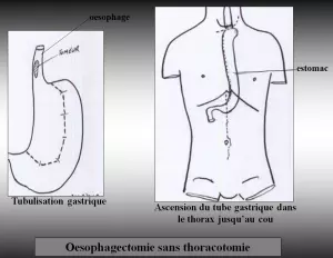 Oesophage - Oesophagectomie sans thoracotomie