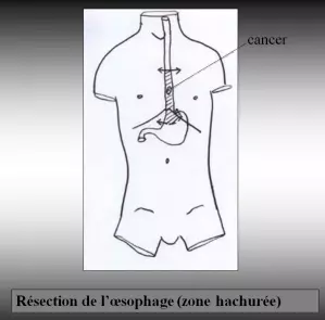 Oesophage - Résection 2