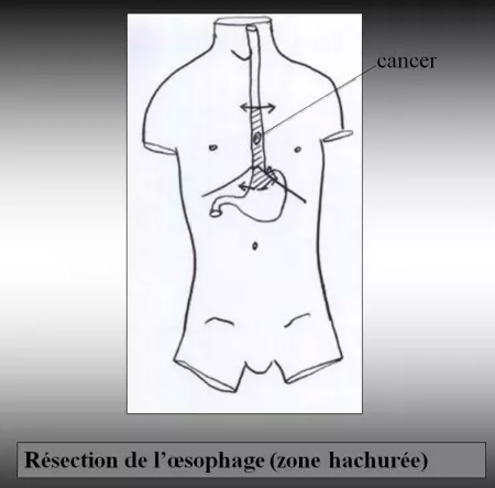 Oesophage - Résection 2