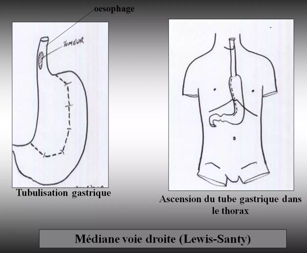 Oesophage - Médiane voie droite (Lewis-Santy)