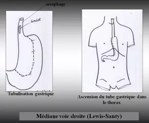 Oesophage - Médiane voie droite (Lewis-Santy)