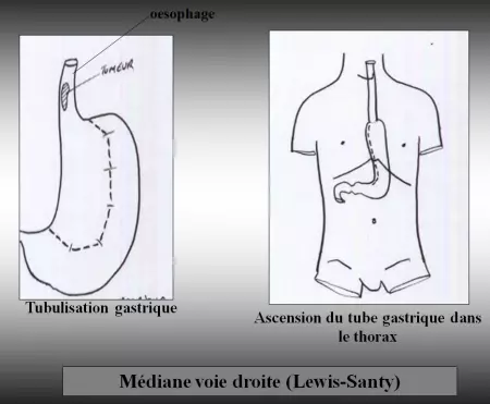 Oesophage - Médiane voie droite (Lewis-Santy)