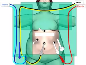 Chirurgie bariatrique - Sleeve_4 - Ibode