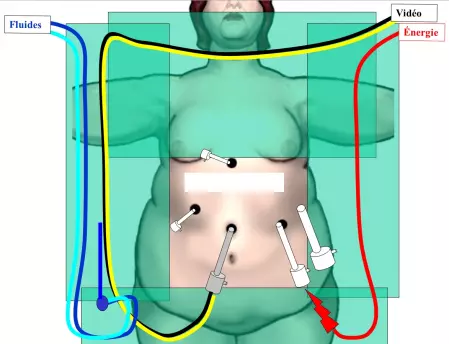 Chirurgie bariatrique - Sleeve_4 - Ibode
