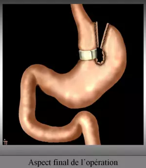 Gastroplastie verticale calibrée