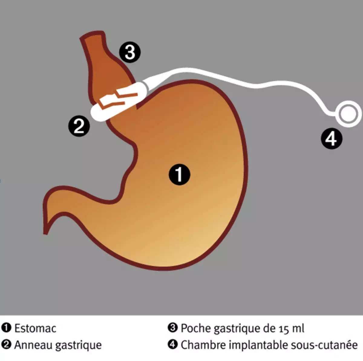 Anneau gastrique