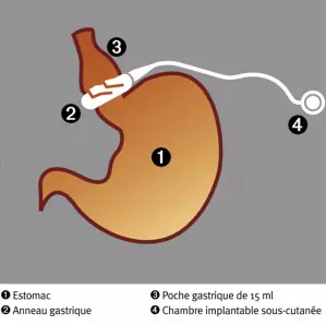 Anneau gastrique