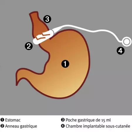 Anneau gastrique