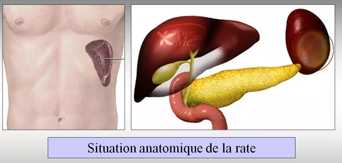 Splénectomie