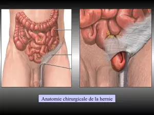 Cure de hernie inguinale sous coelioscopie