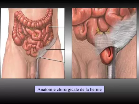 Cure de hernie inguinale sous coelioscopie