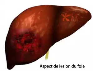 Hépatectomie droite