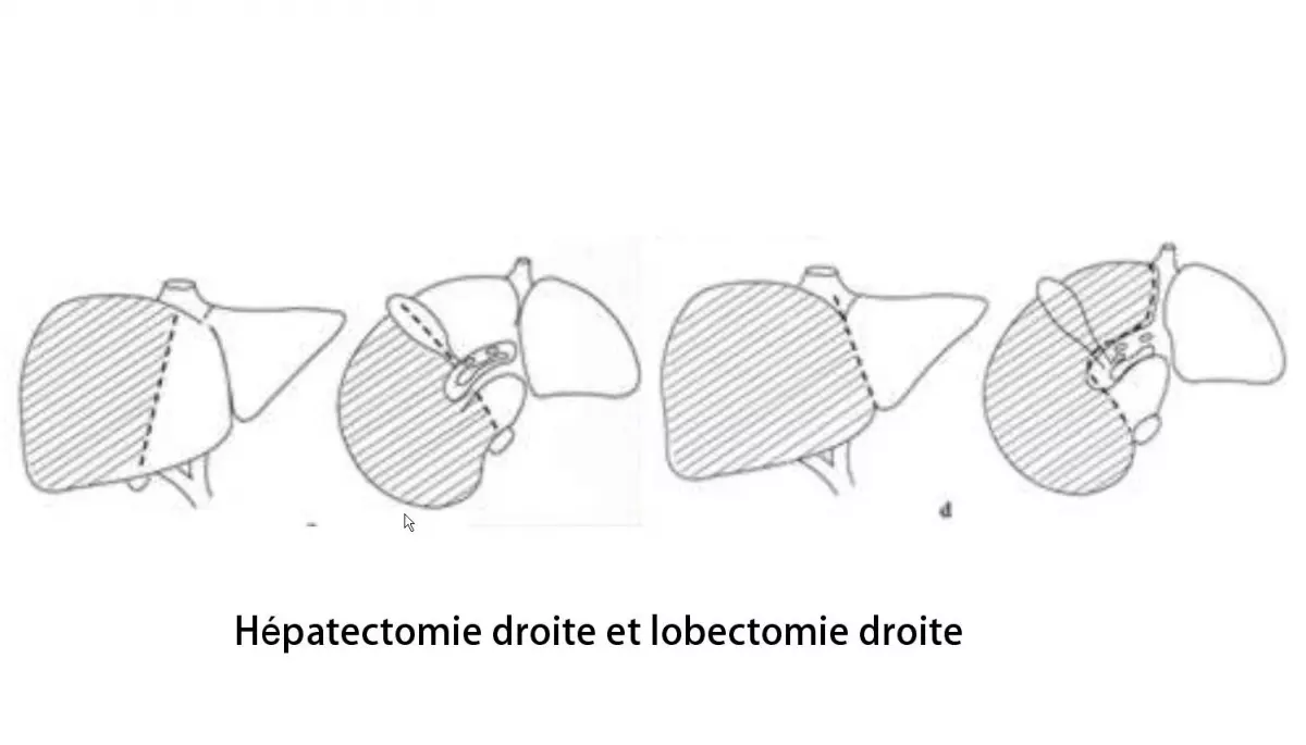 Hépatectomie droite 3