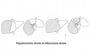 Hépatectomie droite 3