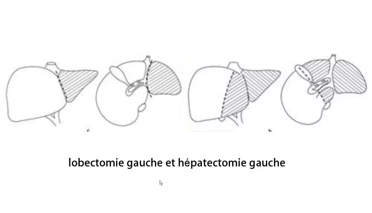 Lobectomie gauche