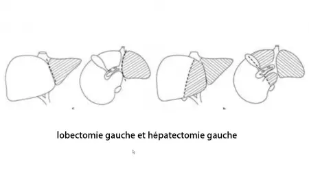 Lobectomie gauche
