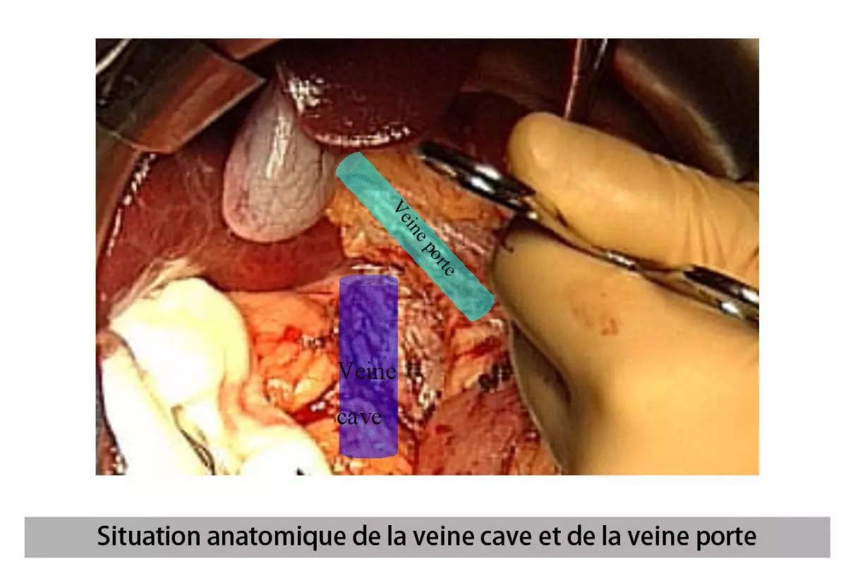 Anastomose porto cave - PATIENTS