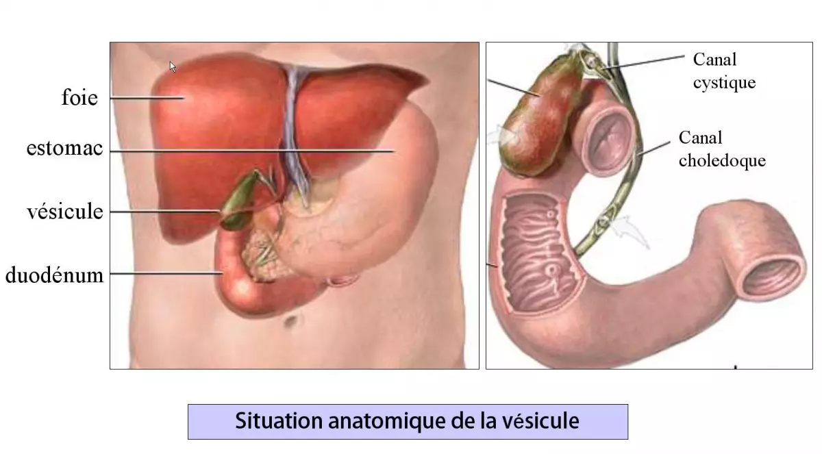 Cholecystectomie