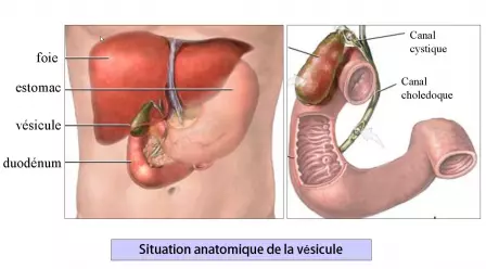 Cholecystectomie