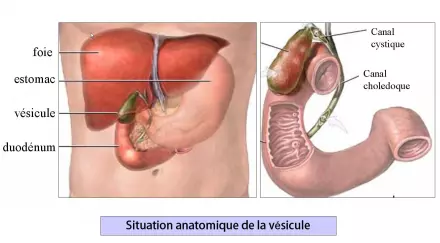 Cholecystectomie