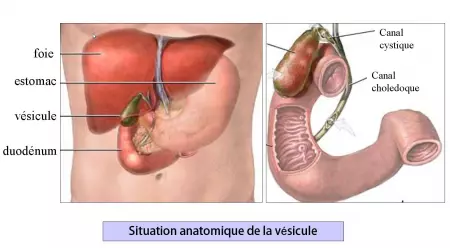 Cholecystectomie