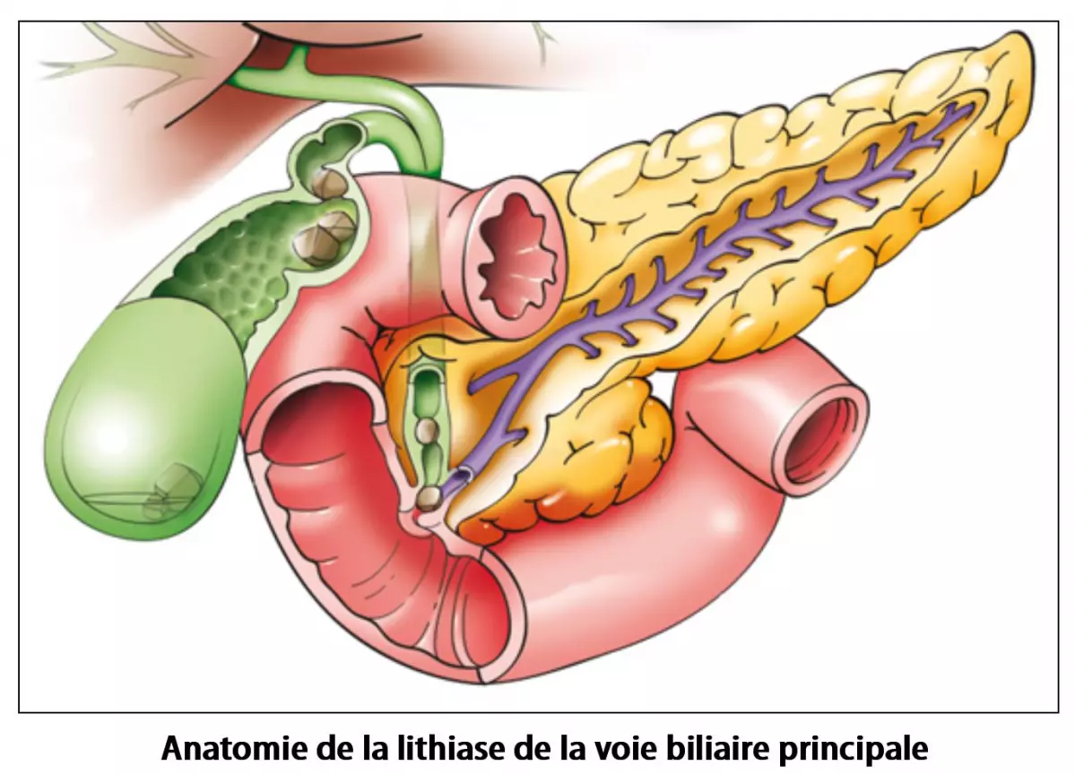Lithiase de la voie biliaire principale