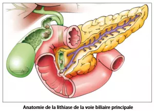 Lithiase de la voie biliaire principale