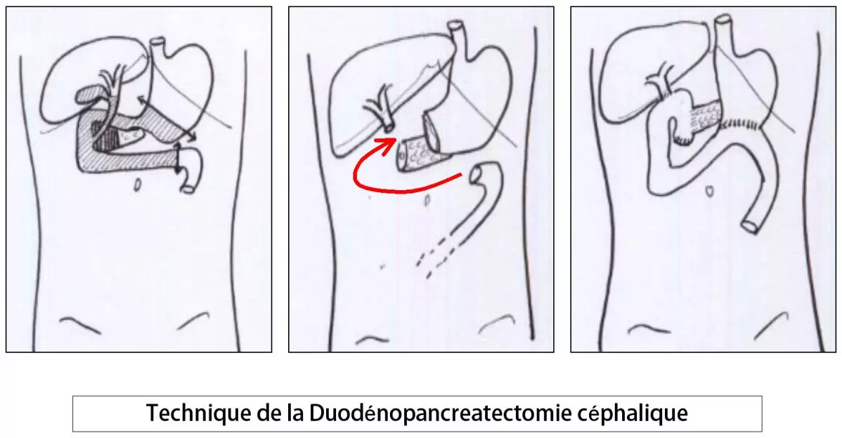 DPC 3