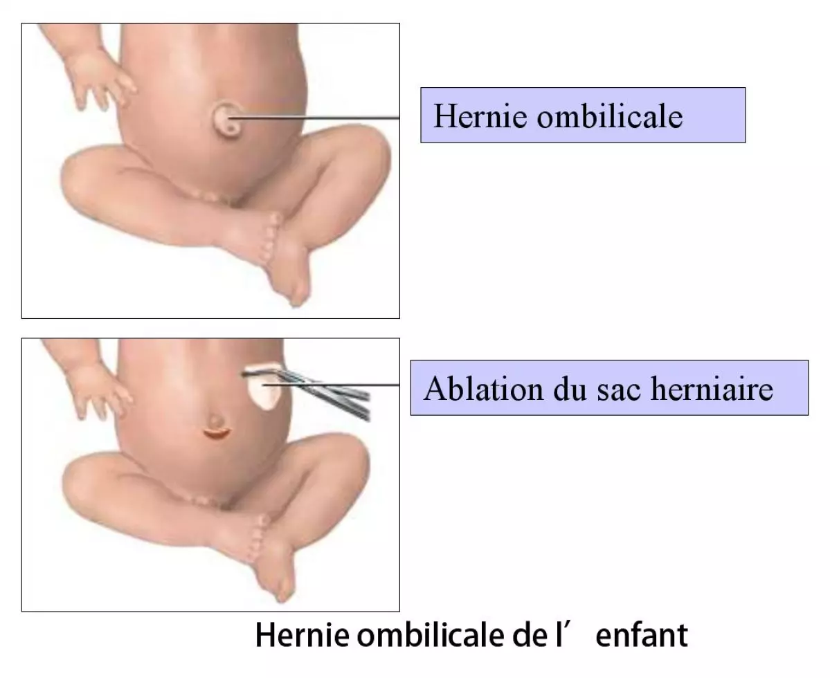 Cure de hernie ombilicale 1
