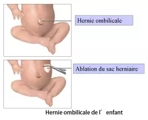 Cure de hernie ombilicale 1
