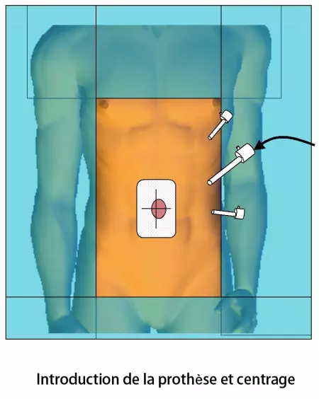 Cure de hernie ombilicale 3
