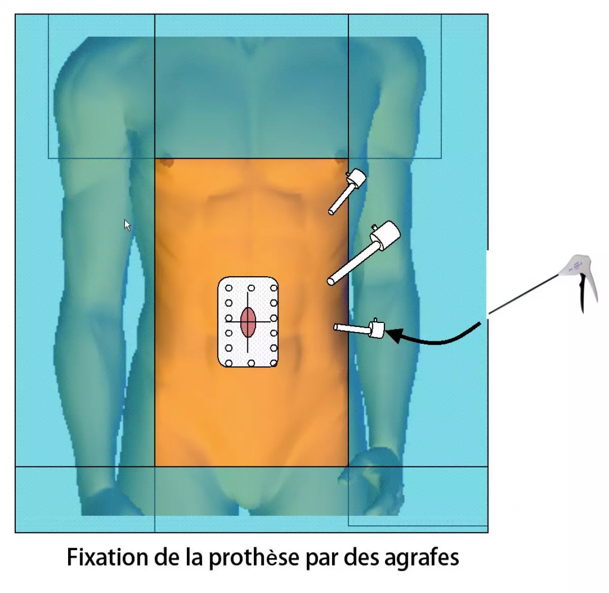 Cure de hernie ombilicale 4