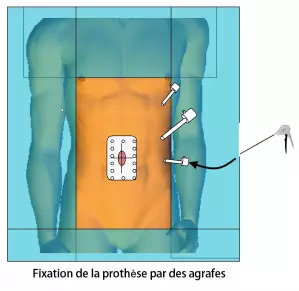 Cure de hernie ombilicale 4