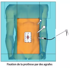 Eventration sous coelioscopie 4