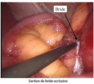 Section de bride sous coelioscopie