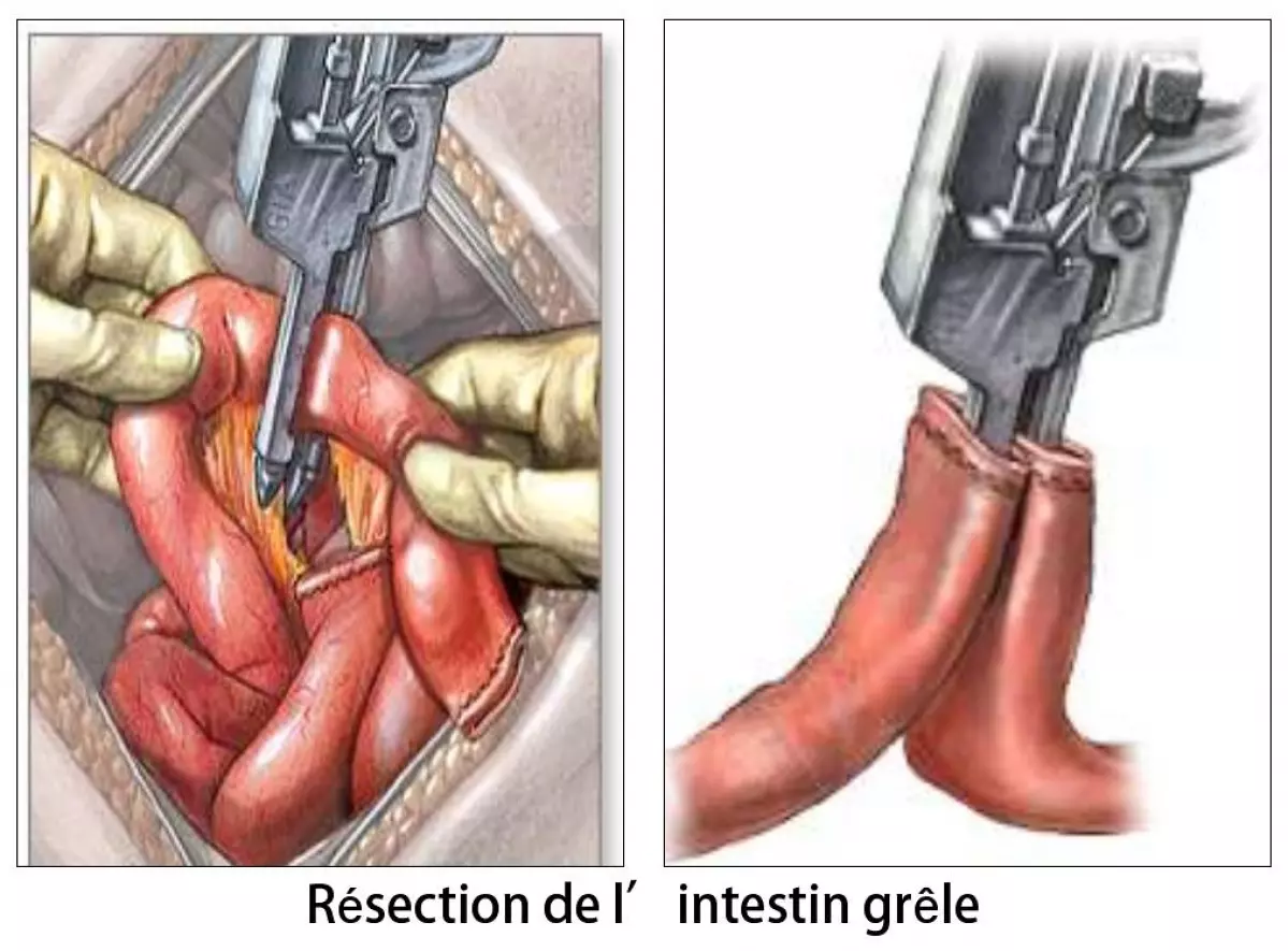 Section de bride avec résection de l'intestin grêle