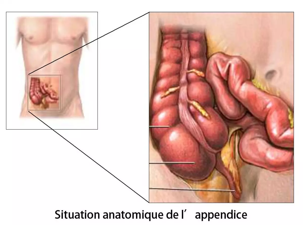 Appendicectomie