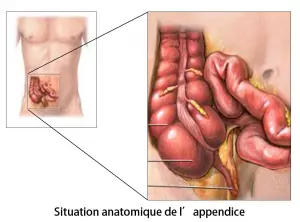 Appendicectomie