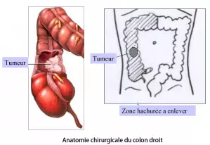 Colectomie droite