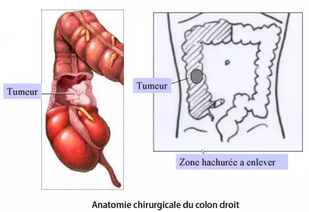 Colectomie droite