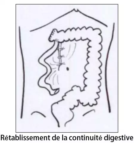 Colectomie droite 3
