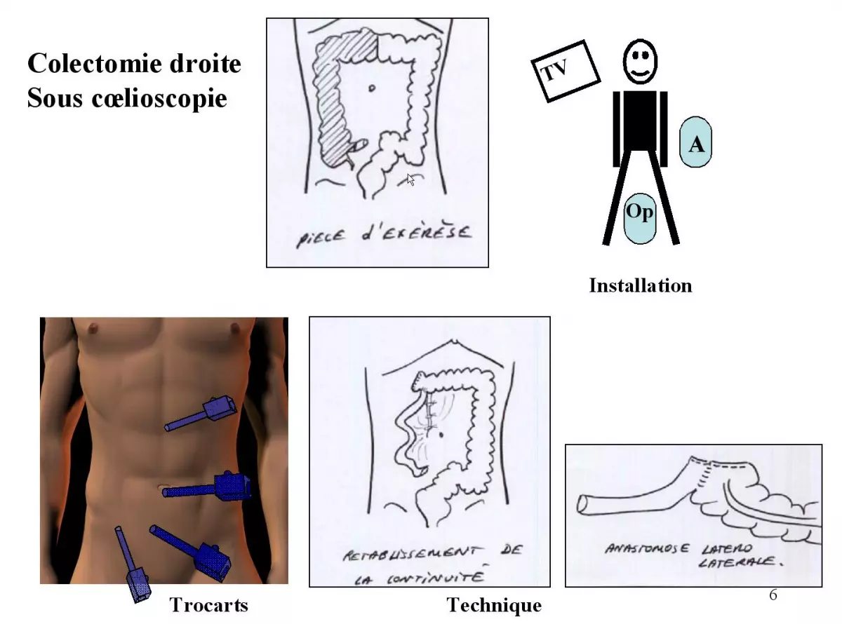 Colectomie droite 5