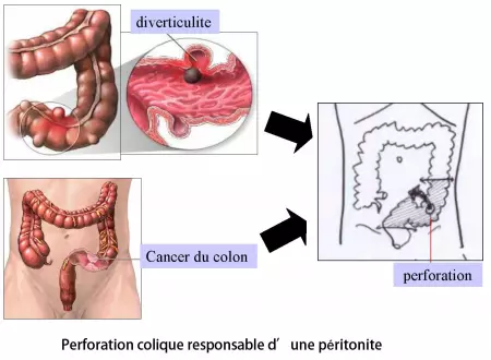 Intervention de Hartmann