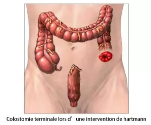 Fermeture de colostomie