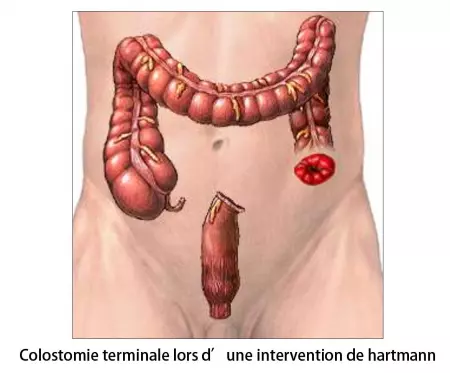 Fermeture de colostomie